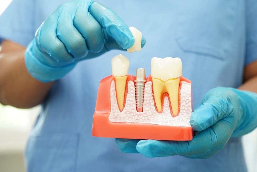 Doctor hold dental implant - Root Canal Tucson